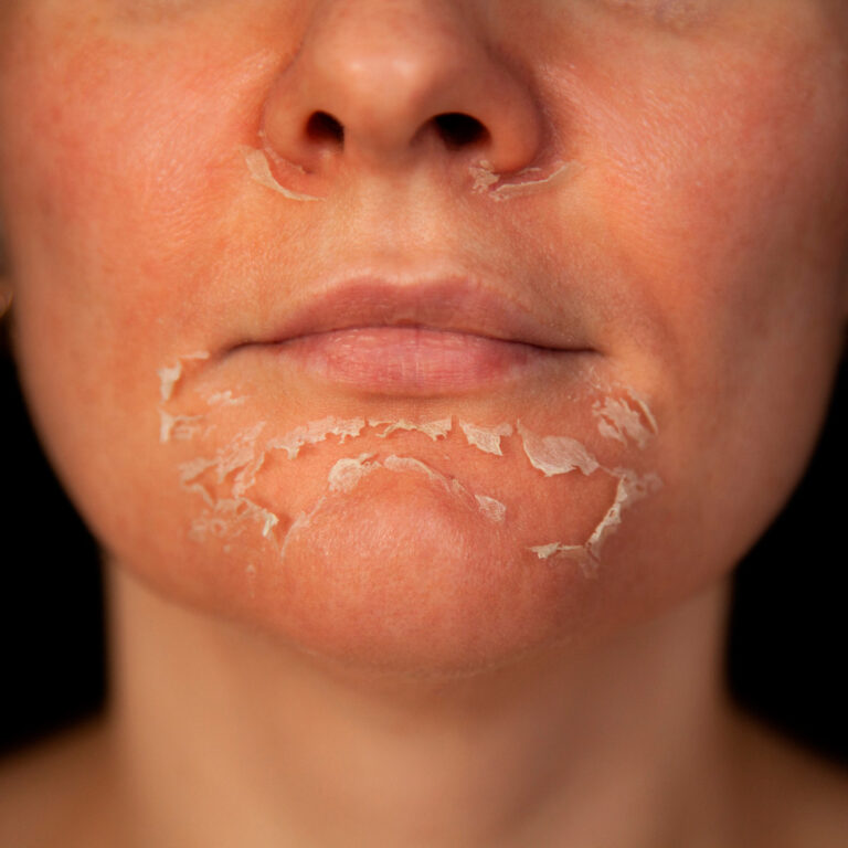 Peeling