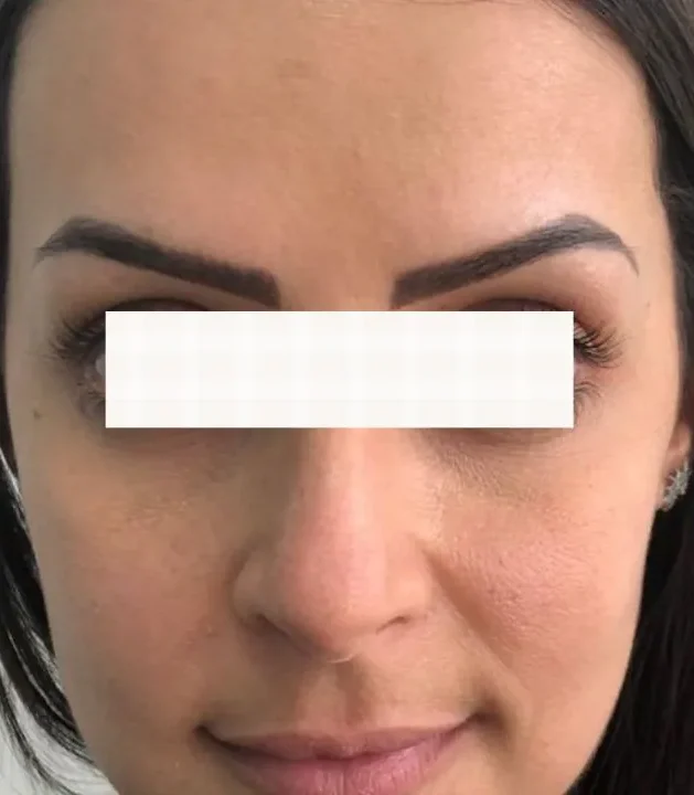 Depois Botox