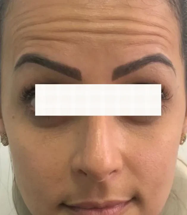 botox antes